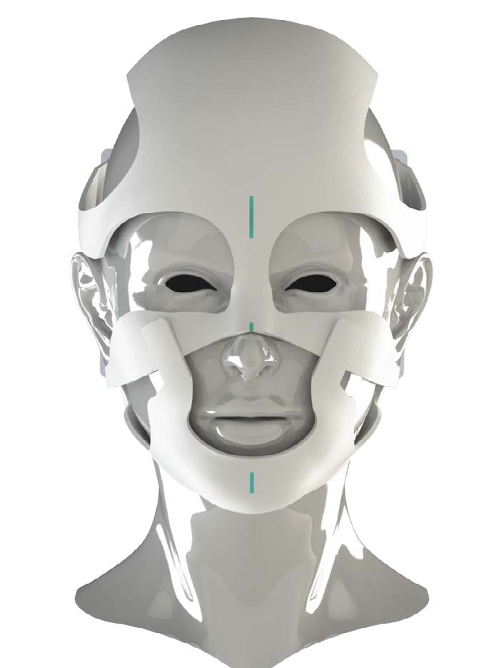 Personalised mask for radiotherapy
